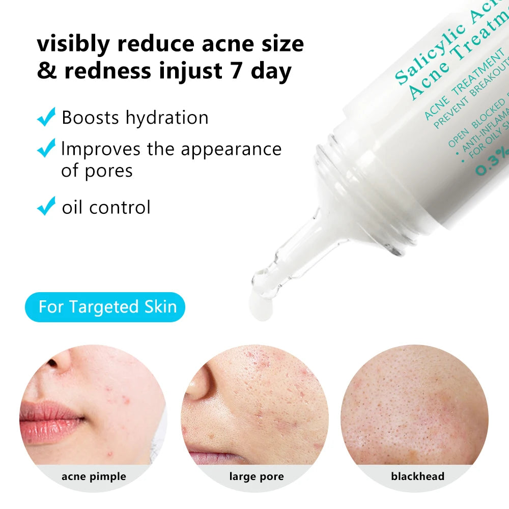 Salicylic Acid 2% Acne Treatment Cream - with Niacinamide for Pore Cleaning, Blackhead Removal & Oil Control